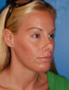 Facial Fat Grafting case #4495