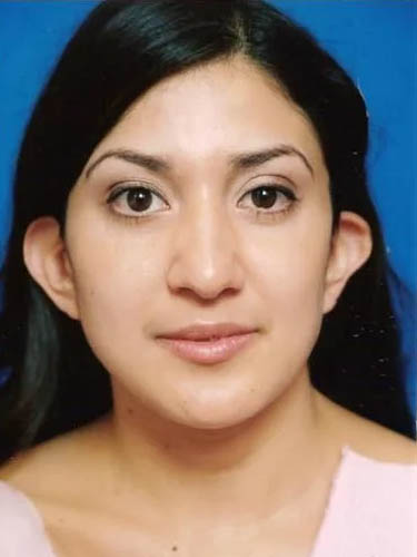 Otoplasty case #5029