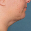 Kybella case #4634