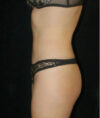 Liposuction case #4678