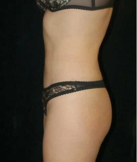 Liposuction case #4678