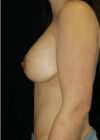Revision Breast Augmentation with Benelli Lift case #3890