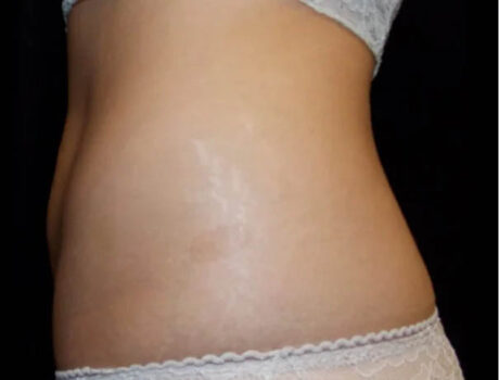 Coolsculpting case #4309