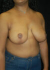 Breast Reduction case #4068