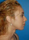 Chin Implant case #4193