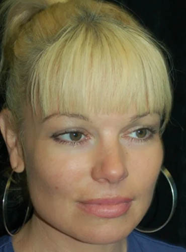 Buccal Fat Removal case #4117