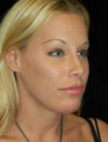 Facial Fat Grafting case #4495