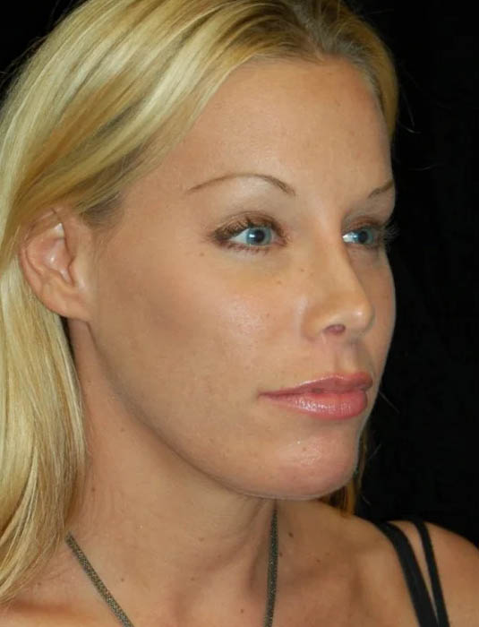 Facial Fat Grafting case #4495