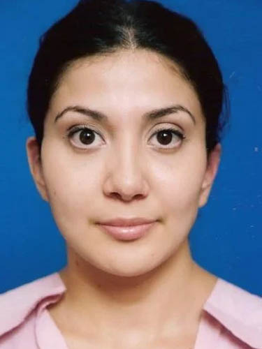 Otoplasty case #5029
