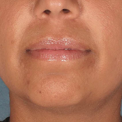 Kybella case #4639