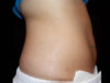 Coolsculpting case #4309