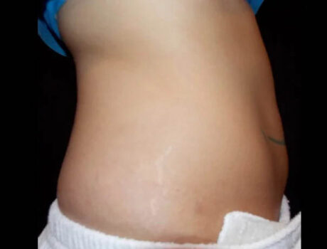 Coolsculpting case #4309