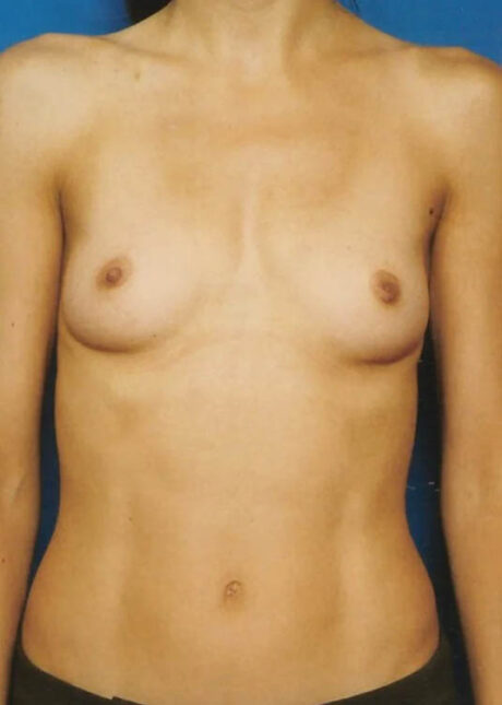 Breast Augmentation case #3636