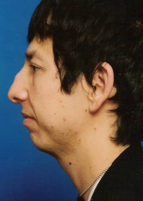 Chin Implant case #4196
