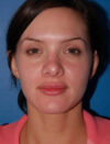 Facial Fat Grafting case #4500