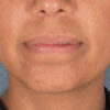Kybella case #4639