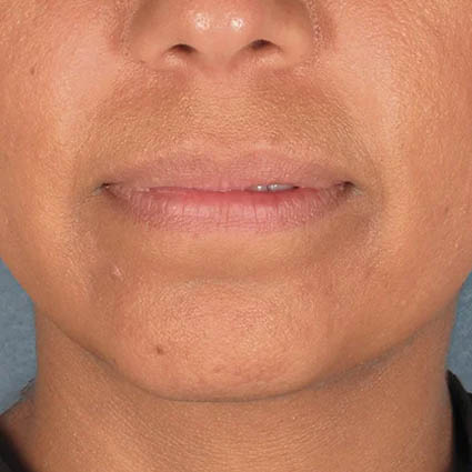 Kybella case #4639