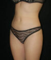 Liposuction case #4678