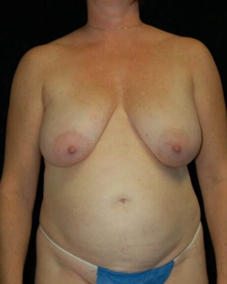 Mommy Makeover case #4831