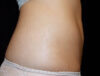 Coolsculpting case #4309