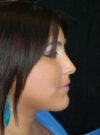 Buccal Fat Removal case #4122