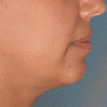 Kybella case #4639