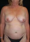 Breast Augmentation with Full Lift case #3933