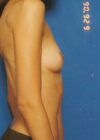 Breast Augmentation case #3636