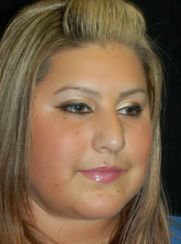 Buccal Fat Removal case #4122