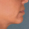 Kybella case #4639