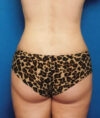 Liposuction case #4685