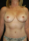 Breast Augmentation with Full Lift case #3933