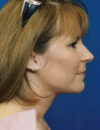 Neck Liposuction case #4946