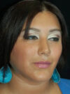 Buccal Fat Removal case #4122