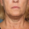 Kybella case #4644