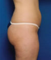 Liposuction case #4685