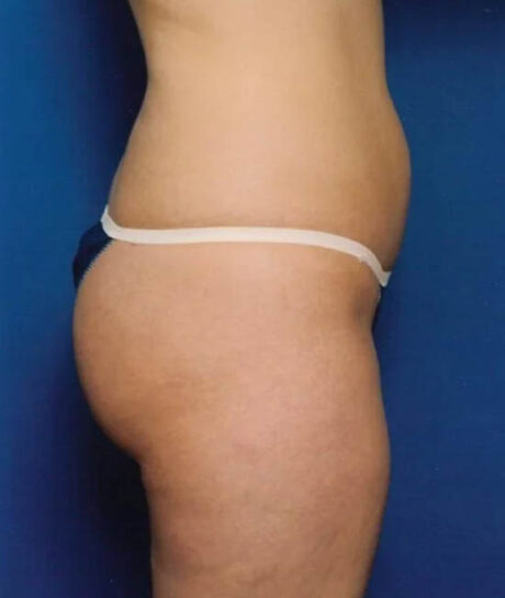 Liposuction case #4685