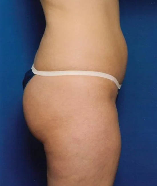 Liposuction case #4685