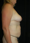 Breast Augmentation with Full Lift case #3933
