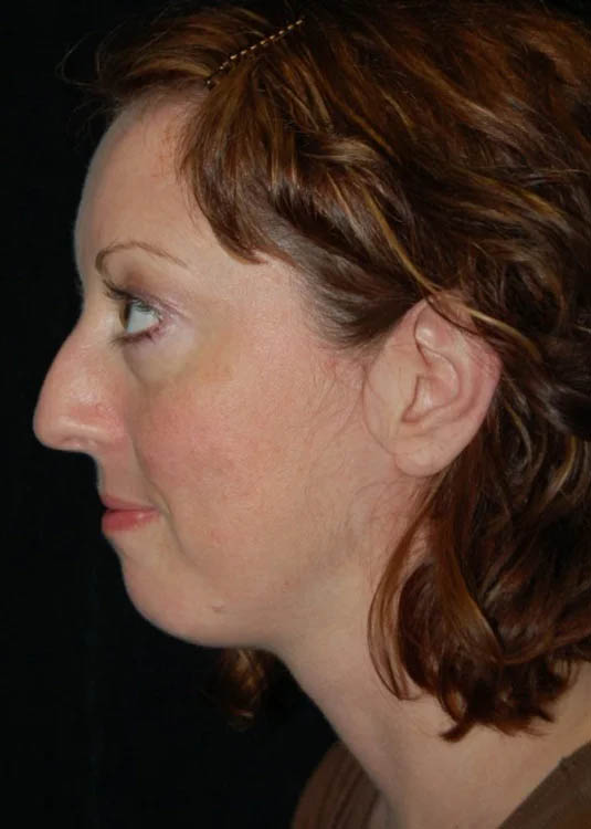 Chin Implant case #4199