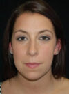 Buccal Fat Removal case #4127