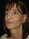 Facial Fat Grafting case #4503