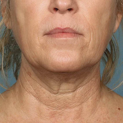 Kybella case #4644