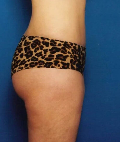 Liposuction case #4685