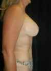 Breast Augmentation with Full Lift case #3933