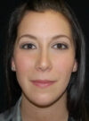 Buccal Fat Removal case #4127