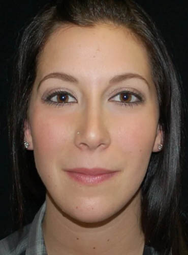 Buccal Fat Removal case #4127