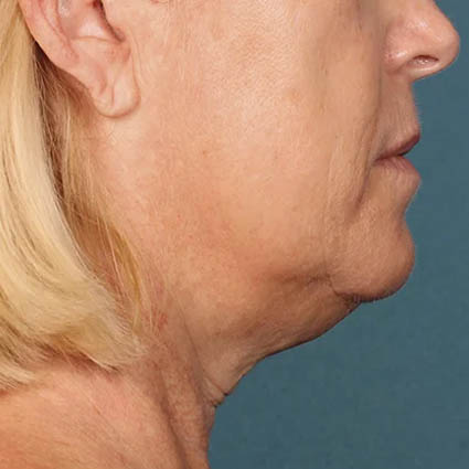 Kybella case #4644