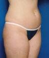 Liposuction case #4685