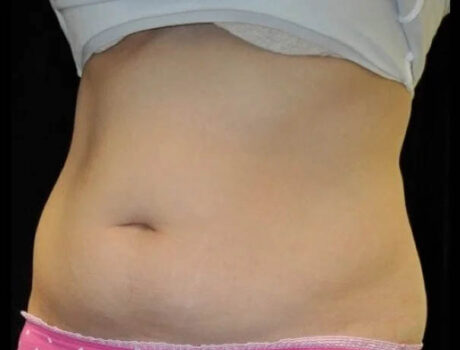 Coolsculpting case #4316